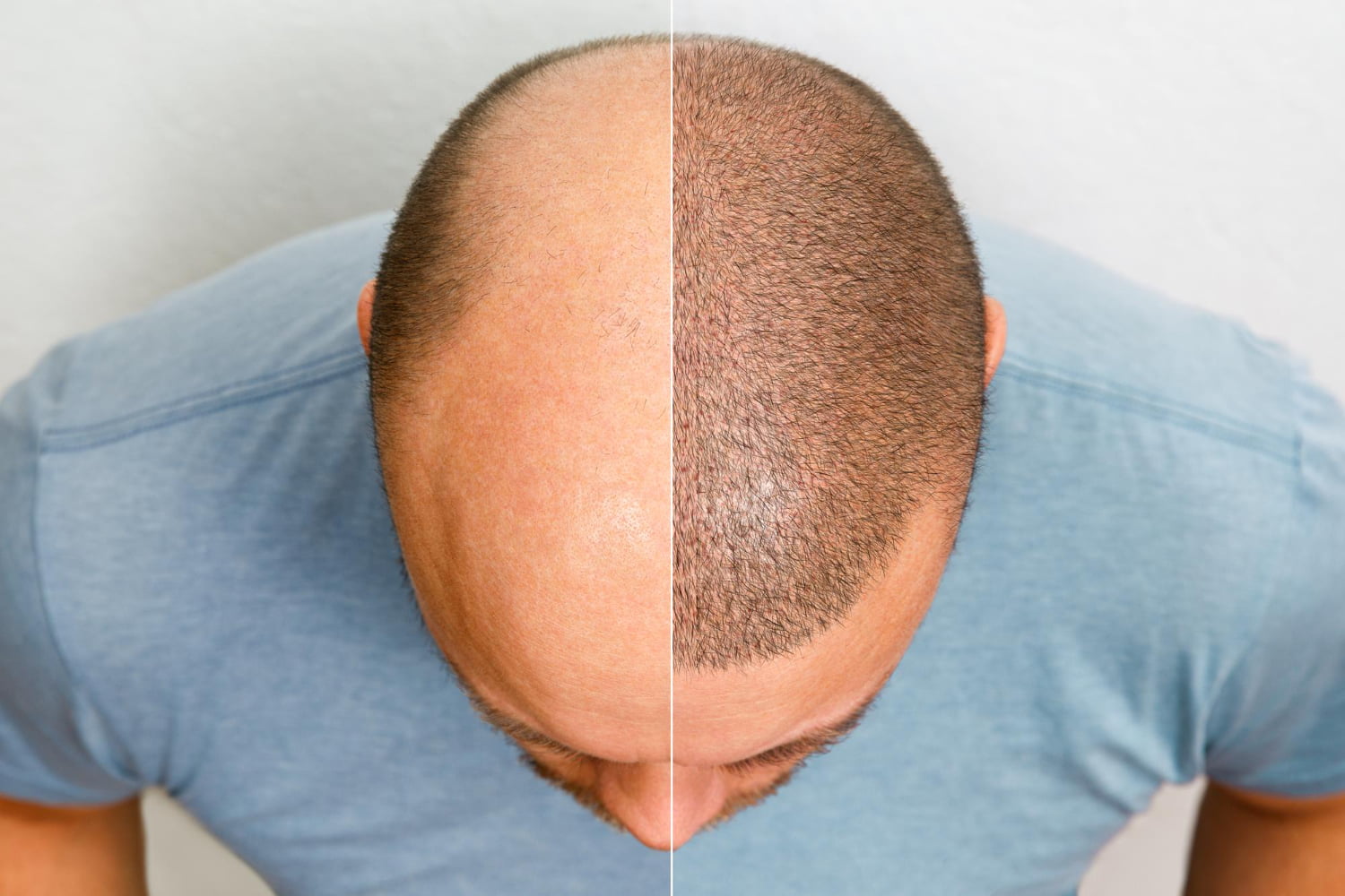 Micropigmentation
